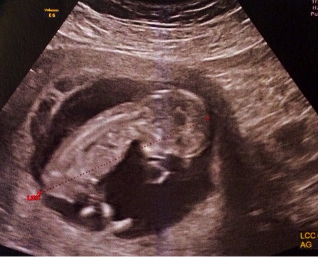 Echo Des 3 Mois Fille Ou Garcon Echographie Connaitre Le Sexe De Votre Bebe Forum Grossesse Amp Bebe Doctissimo Echo Des 3 Mois Fille Ou Garcon Echographie Connaitre Le Sexe De Votre Bebe Forum Grossesse Amp Bebe Doctissimo