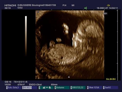 Battement Du Coeur Du Bb Fille Ou Garcon Echo De Karoleen