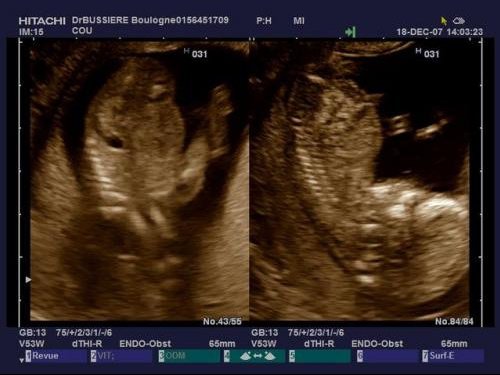 Battement Du Coeur Du Bb Fille Ou Garcon Echo De Karoleen