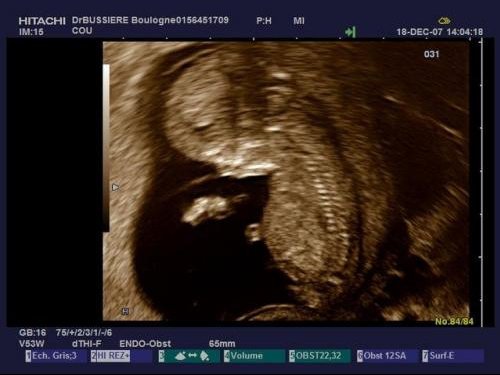 Garcon Ou Fille 9 Mois Vers Toi