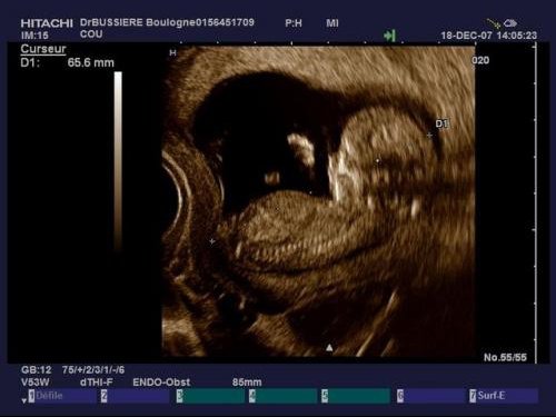 Battement Du Coeur Du Bb Fille Ou Garcon Echo De Karoleen