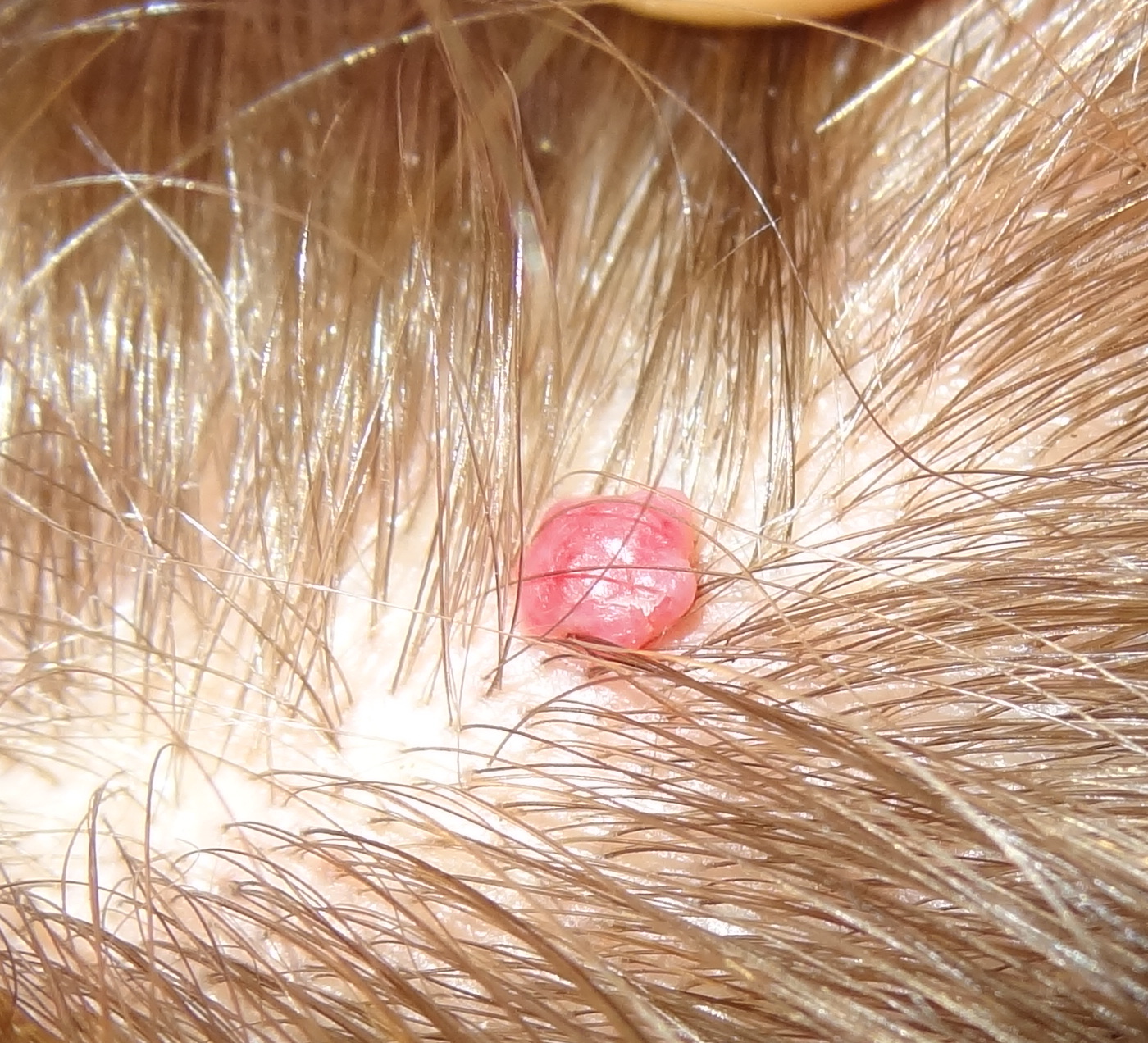 Bouton Rouge Depuis Des Annees Sur Cuir Chevelu Acne Psoriasis Et Problemes De Peau Forum Sante Doctissimo Bouton Rouge Depuis Des Annees Sur Cuir Chevelu Acne Psoriasis Et Problemes De Peau Forum Sante Doctissimo