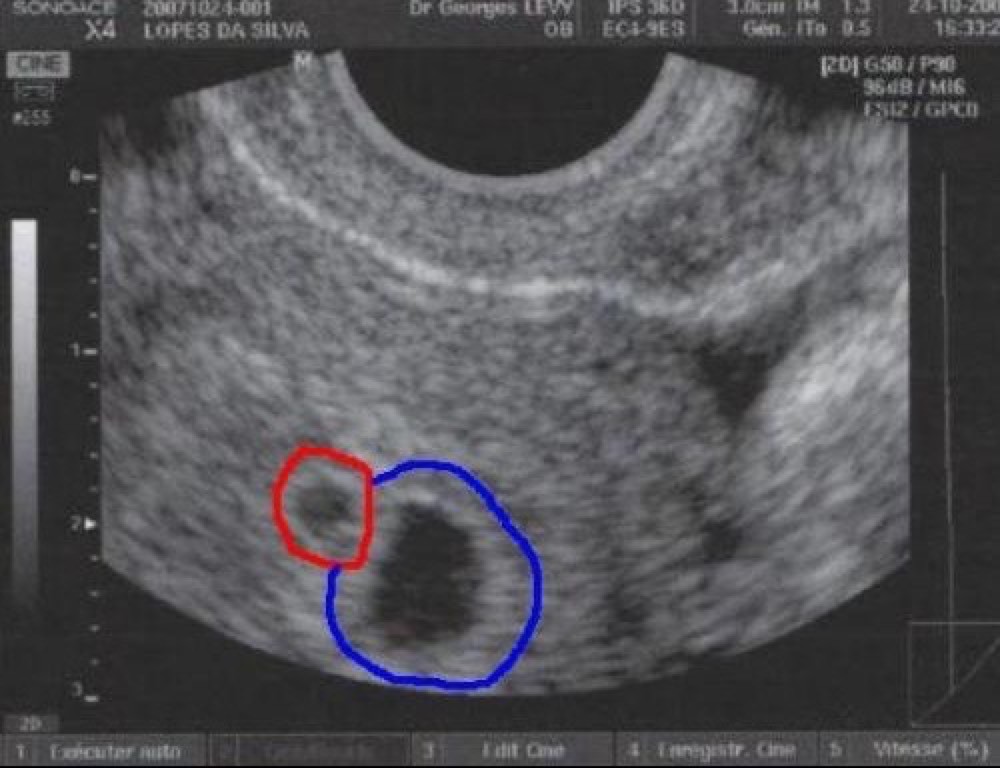 التنزه العمل افتراء 7sa 2 Sacs Gestationnels Devinandthedarklight Com التنزه العمل افتراء 7sa 2 Sacs Gestationnels Devinandthedarklight Com