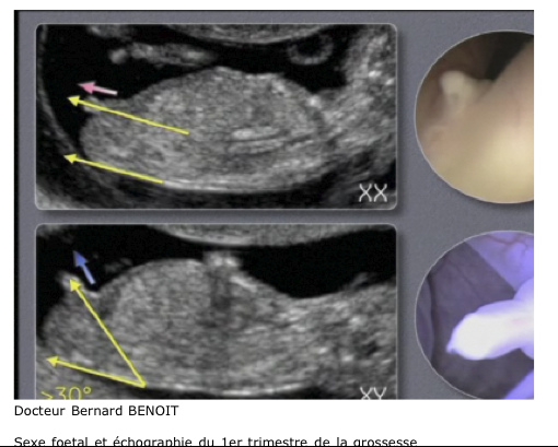Bb3 Le Verdict Est Tombe Echographie Forum Grossesse Bebe