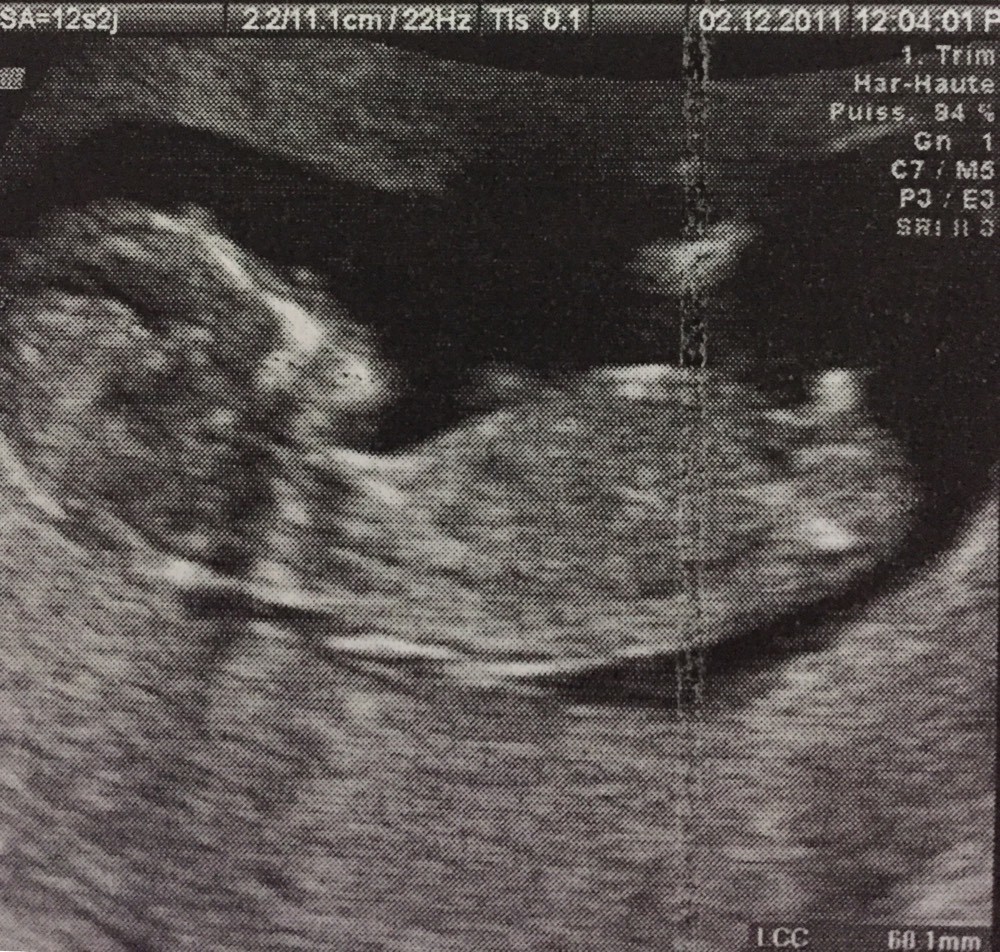 Les Bourgeons Garcons A 12 Sa Echographie Connaitre Le Sexe De Votre Bebe Forum Grossesse Amp Bebe Doctissimo Les Bourgeons Garcons A 12 Sa Echographie Connaitre Le Sexe De Votre Bebe Forum Grossesse Amp Bebe Doctissimo