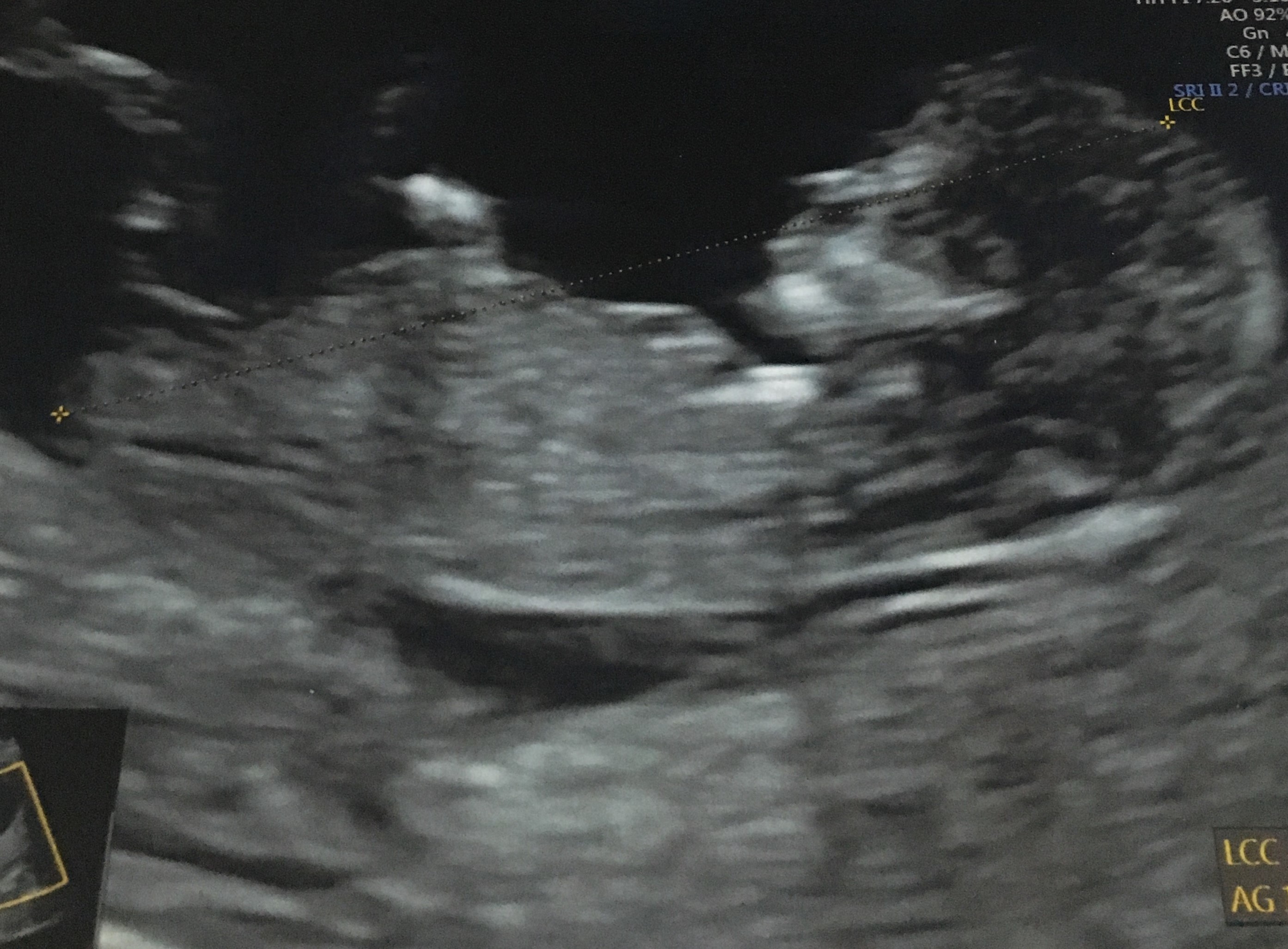 Tubercule 12 Sa Echographie Connaitre Le Sexe De Votre Bebe Forum Grossesse Amp Bebe Doctissimo Tubercule 12 Sa Echographie Connaitre Le Sexe De Votre Bebe Forum Grossesse Amp Bebe Doctissimo