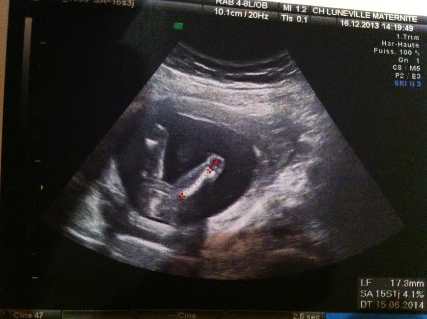Me Revoila Avec Une Nouvelle Echo A 16 Sa Echographie Connaitre Le Sexe De Votre Bebe Forum Grossesse Amp Bebe Doctissimo Me Revoila Avec Une Nouvelle Echo A 16 Sa Echographie Connaitre Le Sexe De Votre Bebe Forum Grossesse Amp Bebe Doctissimo
