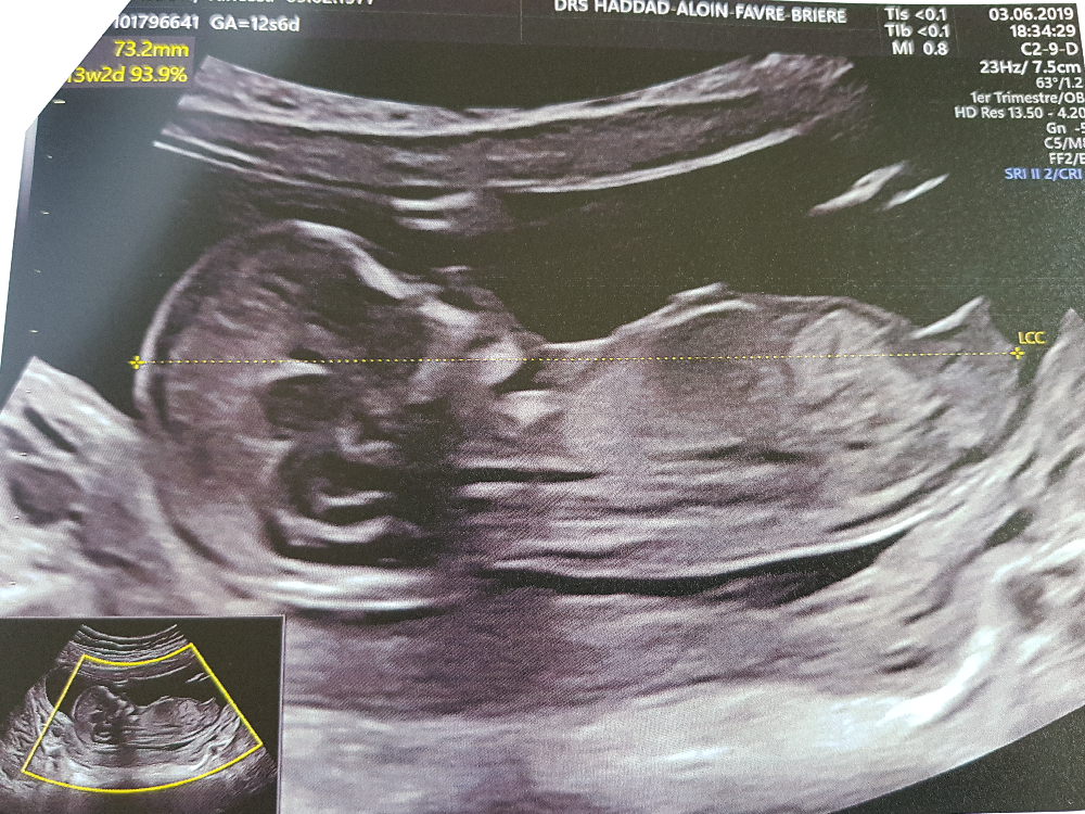 Bonjour Fille Ou Garcon Echographie Connaitre Le Sexe De Votre Bebe Forum Grossesse Amp Bebe Doctissimo Bonjour Fille Ou Garcon Echographie Connaitre Le Sexe De Votre Bebe Forum Grossesse Amp Bebe Doctissimo