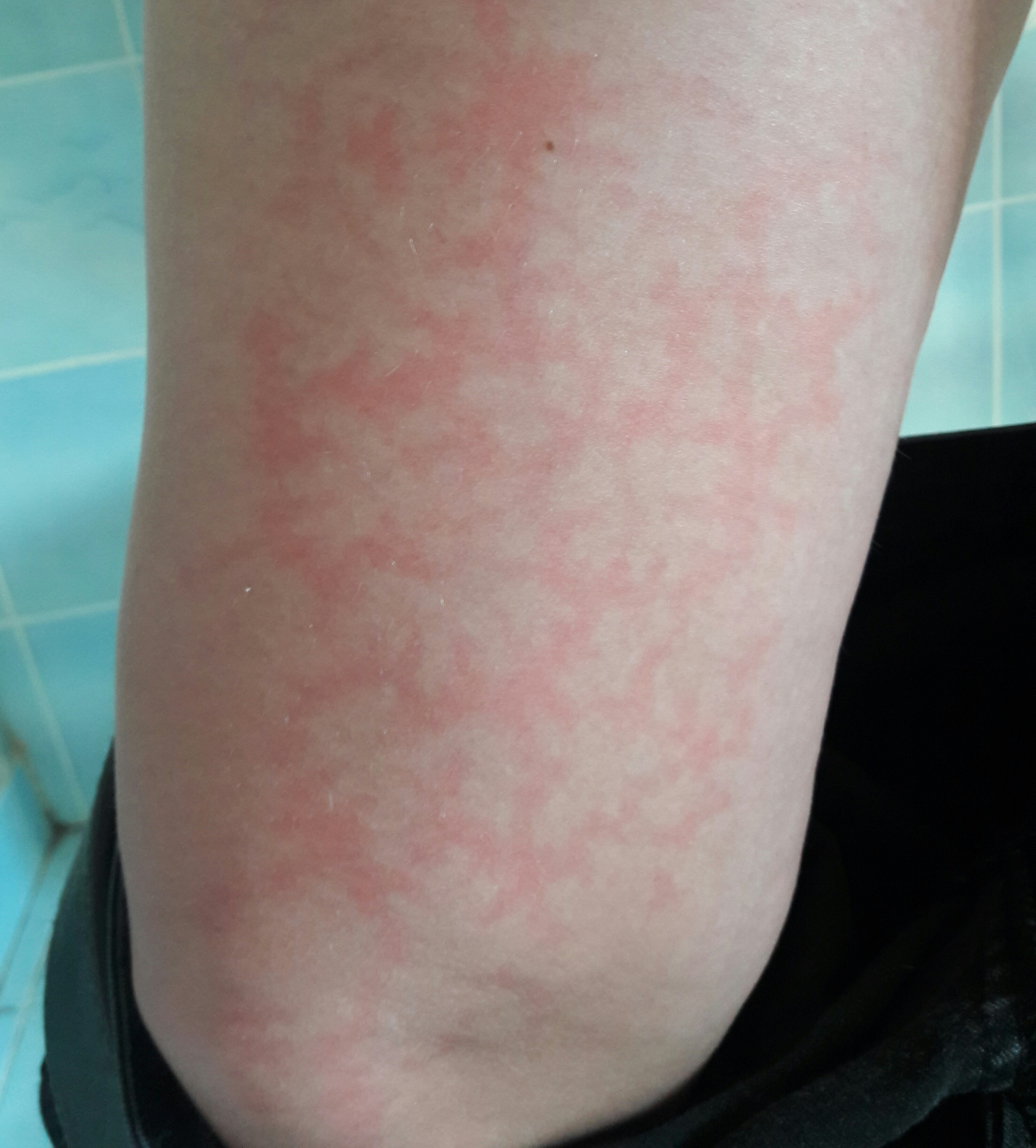 Serait Ce Une Allergie Au Soleil Allergies Et Eczema Forum Sante Doctissimo Serait Ce Une Allergie Au Soleil Allergies Et Eczema Forum Sante Doctissimo