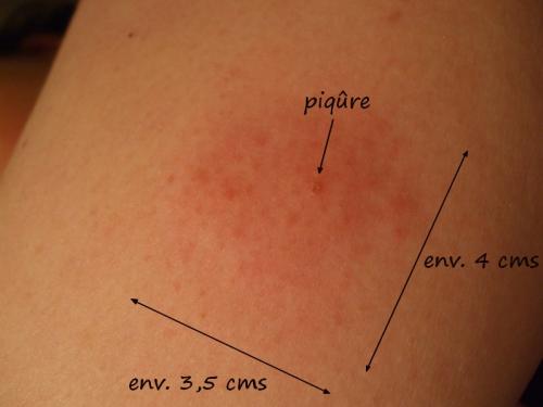 Piqure De Tique Est Ce La Maladie De Lyme Photo Forum Libre Sante Forum Sante Doctissimo