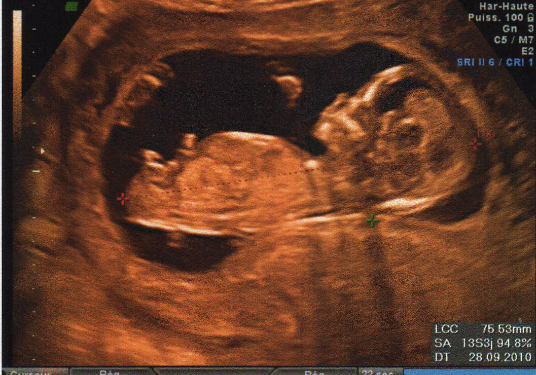 Avis Sur Sexe A 13 Sa Gros Doute Futures Mamans Forum Grossesse Amp Bebe Doctissimo Avis Sur Sexe A 13 Sa Gros Doute Futures Mamans Forum Grossesse Amp Bebe Doctissimo