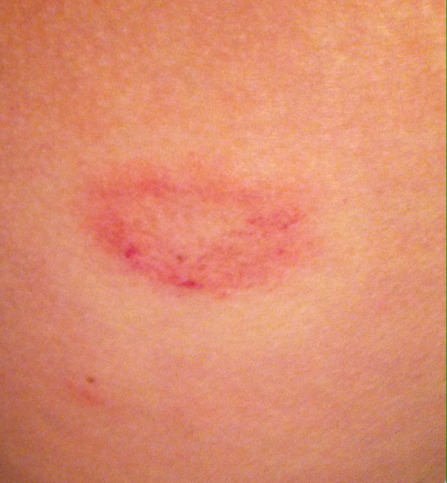 Plaque Rouge Haut Cuisse at Mitchell Fredricksen blog