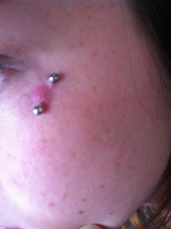 Piercing Oeil De Chat Infecte Ou Pas