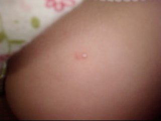 Boutons Sur Les Fesses De Ma Filles Voila A Quoi Ca Ressemble Sante De L Enfant Forum Sante Doctissimo Boutons Sur Les Fesses De Ma Filles Voila A Quoi Ca Ressemble Sante De L Enfant Forum Sante Doctissimo
