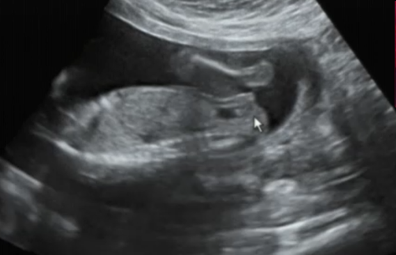 Sexe De Bebe A 16 Semaines De Grossesse Sexe De Bebe A 16 Semaines De Grossesse