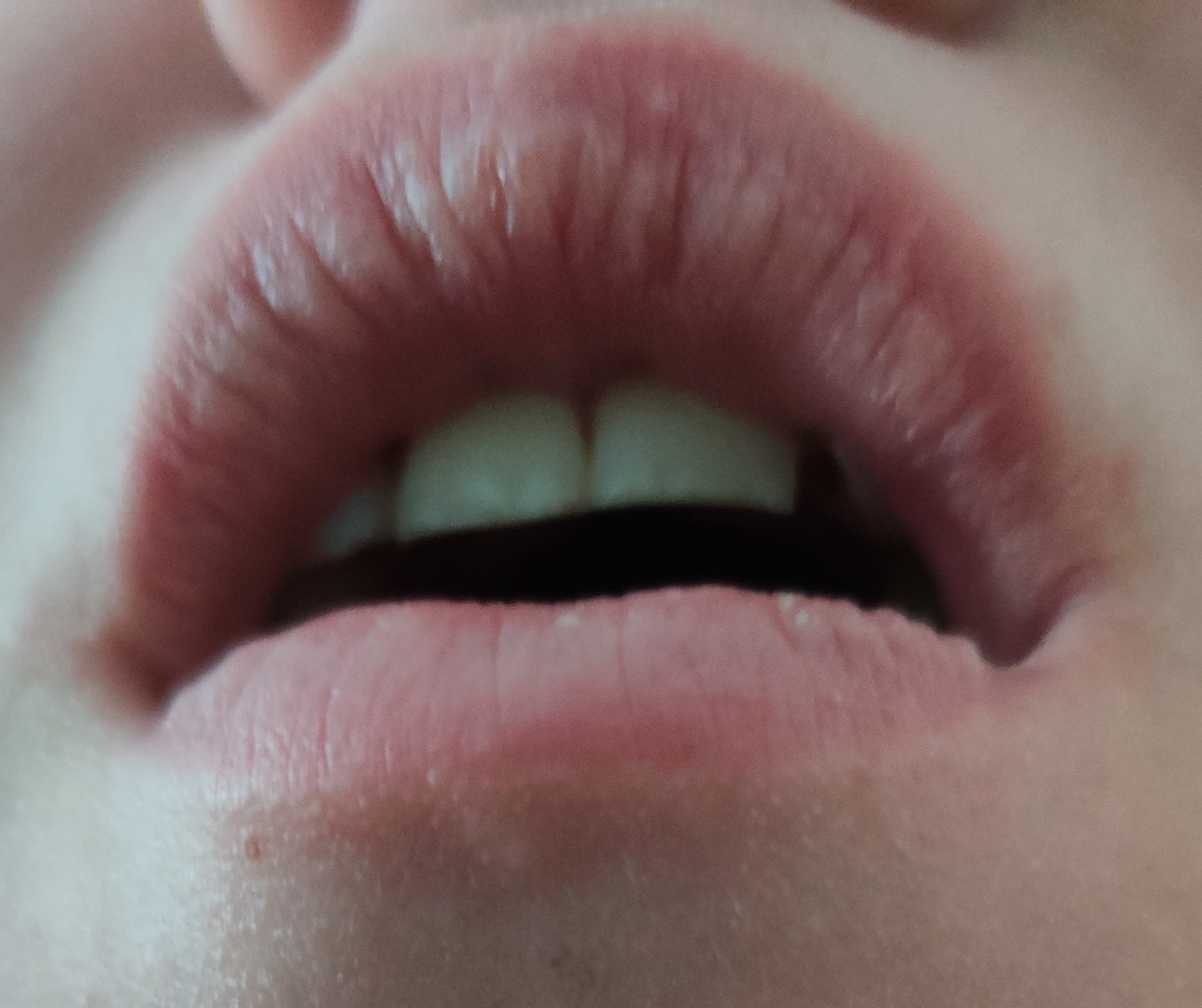 Des Dizaines Centaine De Points Blancs Sur Les Levres Acne Psoriasis Et Problemes De Peau Forum Sante Doctissimo Des Dizaines Centaine De Points Blancs Sur Les Levres Acne Psoriasis Et Problemes De Peau Forum Sante Doctissimo