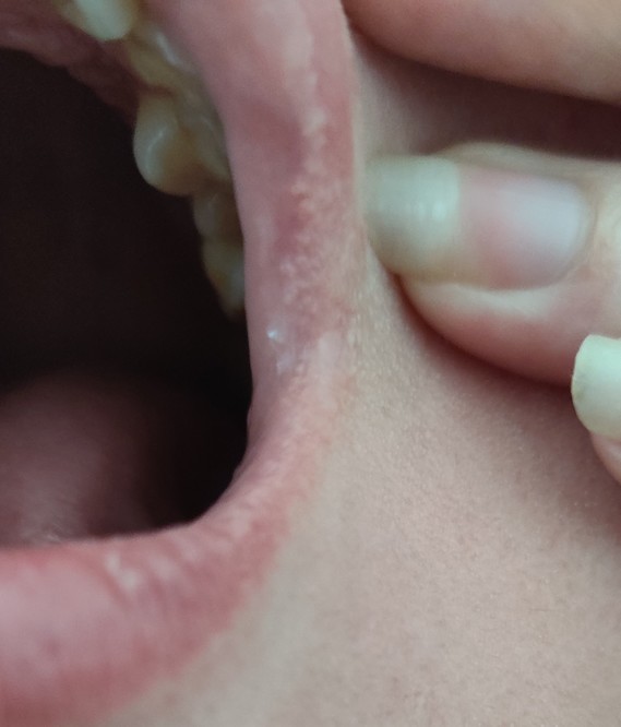 Des Dizaines Centaine De Points Blancs Sur Les Levres Des Dizaines Centaine De Points Blancs Sur Les Levres