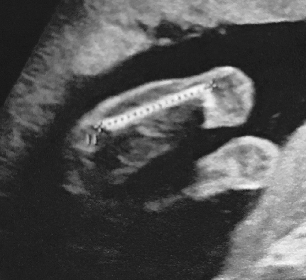 Echo Entrejambe 29sa Perplexe Echographie Connaitre Le Sexe De Votre Bebe Forum Grossesse Amp Bebe Doctissimo Echo Entrejambe 29sa Perplexe Echographie Connaitre Le Sexe De Votre Bebe Forum Grossesse Amp Bebe Doctissimo
