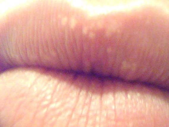 petits boutons blanc sur les lèvres (avec photo) - Soin du ...
