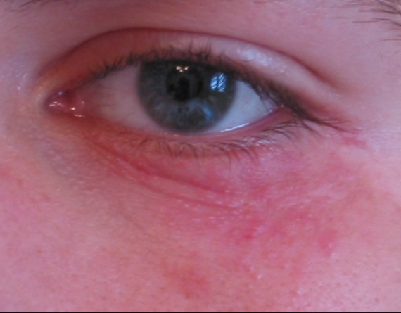 rougeur autour de l'oeil