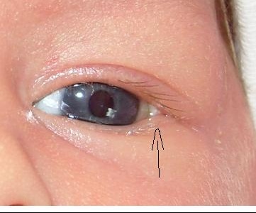 Bebe De 7 Mois Drole De Petite Peau Au Coin De L Oeil Myopie Cataracte Et Problemes De Vue Forum Sante Doctissimo Bebe De 7 Mois Drole De Petite Peau Au Coin De L Oeil Myopie Cataracte Et Problemes De Vue Forum Sante Doctissimo