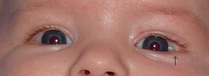 Bebe De 7 Mois Drole De Petite Peau Au Coin De L Oeil Myopie Cataracte Et Problemes De Vue Forum Sante Doctissimo Bebe De 7 Mois Drole De Petite Peau Au Coin De L Oeil Myopie Cataracte Et Problemes De Vue Forum Sante Doctissimo