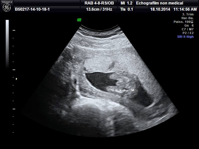 Doute Sexe A 18sa Echographie Connaitre Le Sexe De Votre Bebe Forum Grossesse Amp Bebe Doctissimo Doute Sexe A 18sa Echographie Connaitre Le Sexe De Votre Bebe Forum Grossesse Amp Bebe Doctissimo