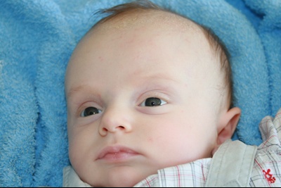 Kyste Arachnoïdien Page 3 Bébés De Lannée Forum