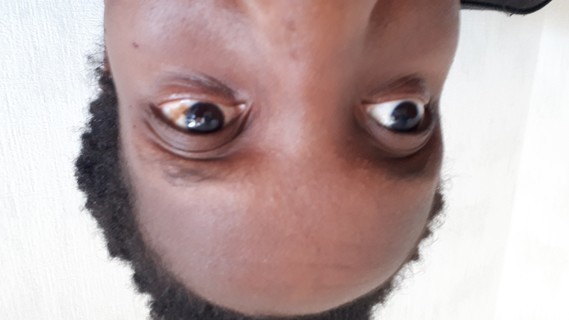 Tache Marron Sur Le Blanc De L Oeil Tache Marron Sur Le Blanc De L Oeil
