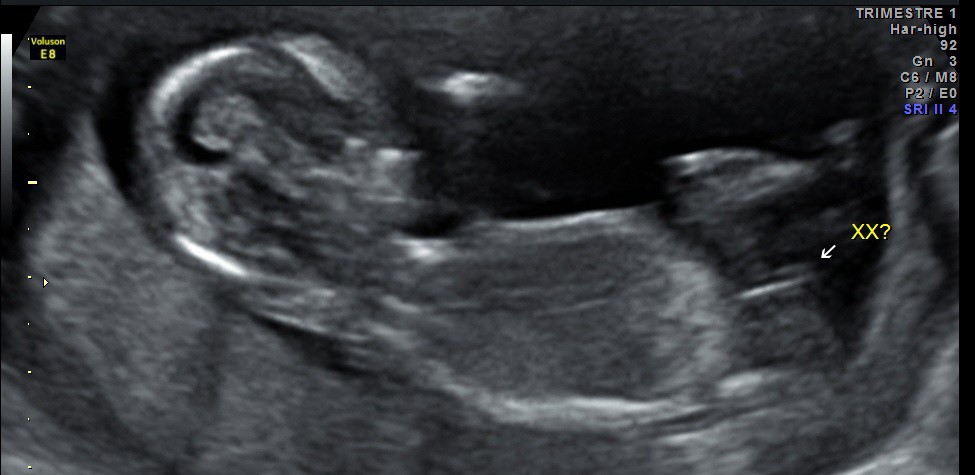 Erreur Lors De L Estimation Sexe Bebe 1 Que Pensez Vous De Celle De Bebe 2 Echographie Connaitre Le Sexe De Votre Bebe Forum Grossesse Amp Bebe Doctissimo Erreur Lors De L Estimation Sexe Bebe 1 Que Pensez Vous De Celle De Bebe 2 Echographie Connaitre Le Sexe De Votre Bebe Forum Grossesse Amp Bebe Doctissimo