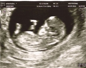 Echo A 11 Semaines Donnez Moi Vos Avis Svp Echographie Connaitre Le Sexe De Votre Bebe Forum Grossesse Amp Bebe Doctissimo Echo A 11 Semaines Donnez Moi Vos Avis Svp Echographie Connaitre Le Sexe De Votre Bebe Forum Grossesse Amp Bebe Doctissimo