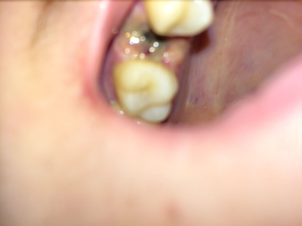 Extraction Pre Molaire Problemes Dentaires Forum Sante