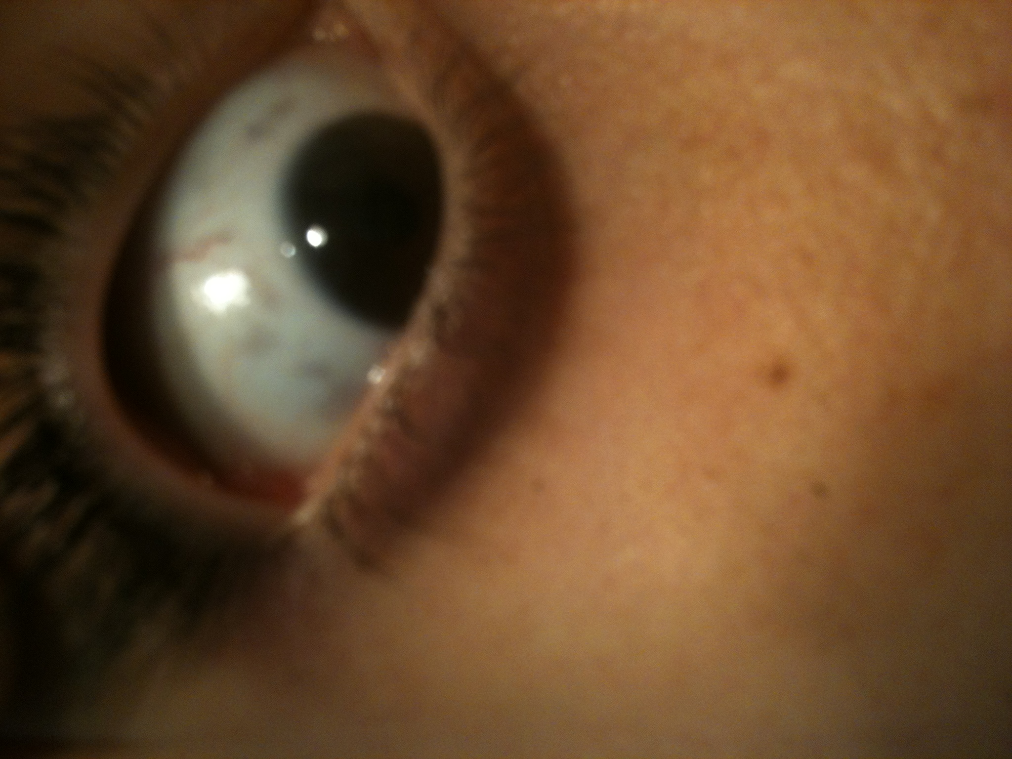 Tache Dans Le Blanc Des Yeux Myopie Cataracte Et Problemes De Vue Forum Sante Doctissimo Tache Dans Le Blanc Des Yeux Myopie Cataracte Et Problemes De Vue Forum Sante Doctissimo