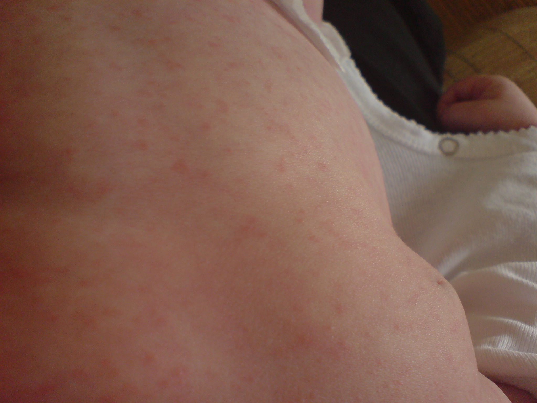 Help Allergie Ou Scarlatine Bebe Grandit Forum Grossesse Amp Bebe Doctissimo Help Allergie Ou Scarlatine Bebe Grandit Forum Grossesse Amp Bebe Doctissimo