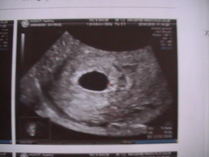 Echographie 6 Sa Oeuf Clair Echographie Connaitre Le Sexe De Votre Bebe Forum Grossesse Amp Bebe Doctissimo Echographie 6 Sa Oeuf Clair Echographie Connaitre Le Sexe De Votre Bebe Forum Grossesse Amp Bebe Doctissimo