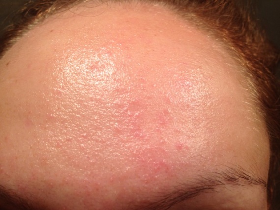 Plaques rouges, démangeaisons pour toute chaleur...