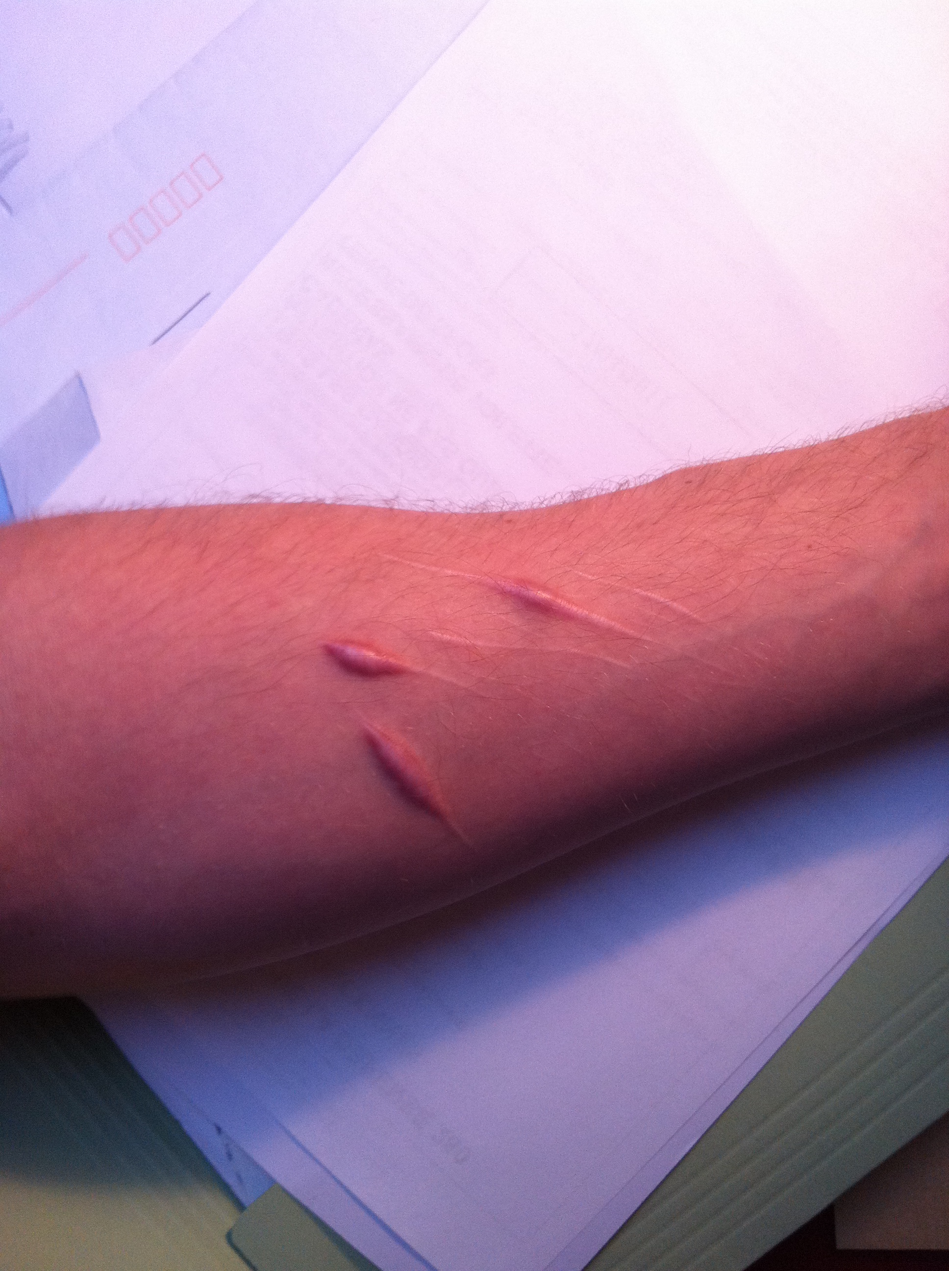 Cicatrices Cheloides Evolution Attention Photos Acne Psoriasis Et Problemes De Peau Forum Sante