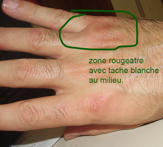 Démangeaisons/douleurs sur mains/doigts après travail + ganglions