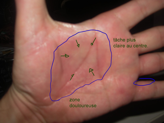 Douleurs paume main et doigts après travaux + ganglions