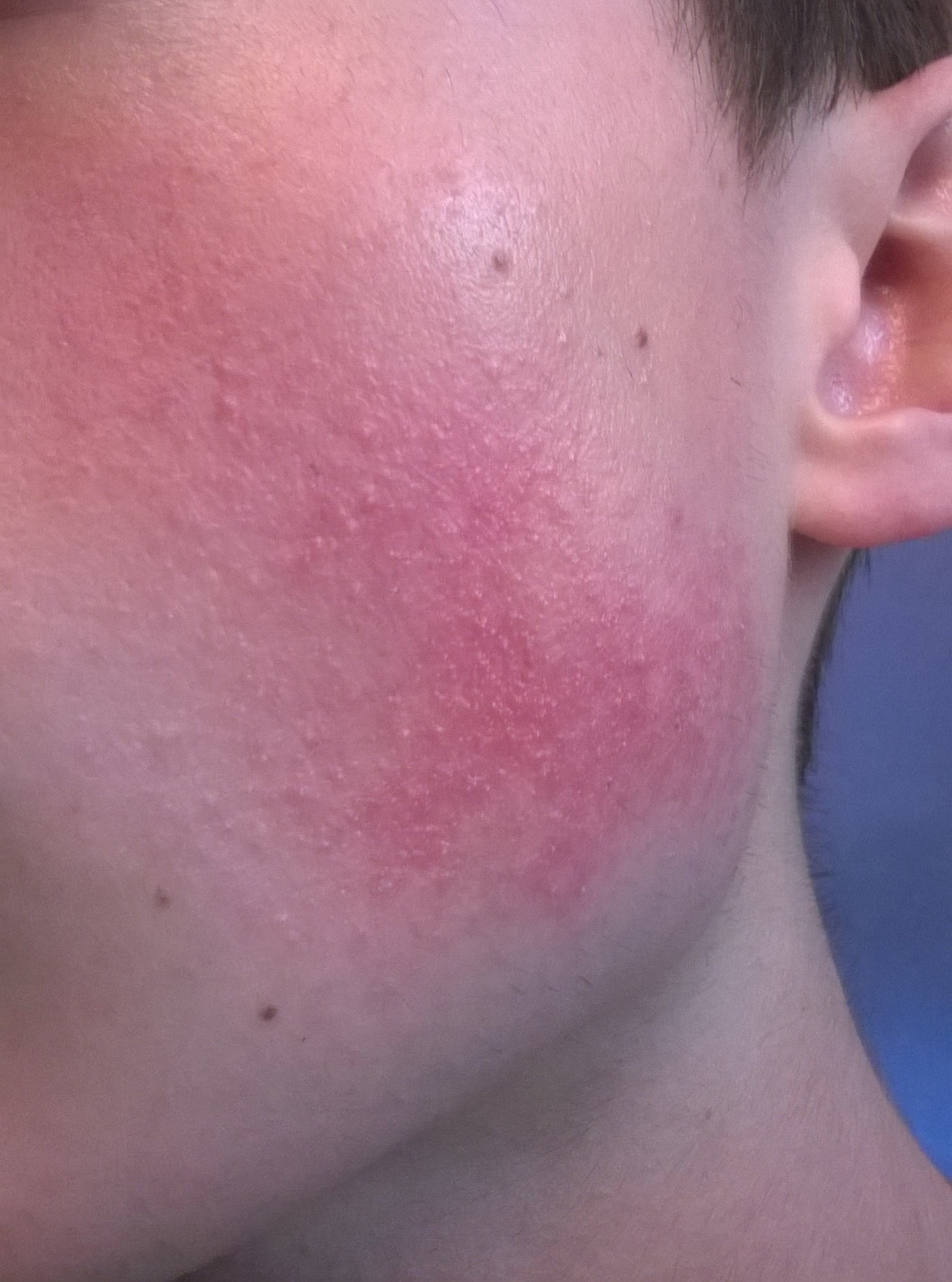 Plaque Rouge Sur Les Joues Allergies Et Eczema Forum Sante Doctissimo Plaque Rouge Sur Les Joues Allergies Et Eczema Forum Sante Doctissimo