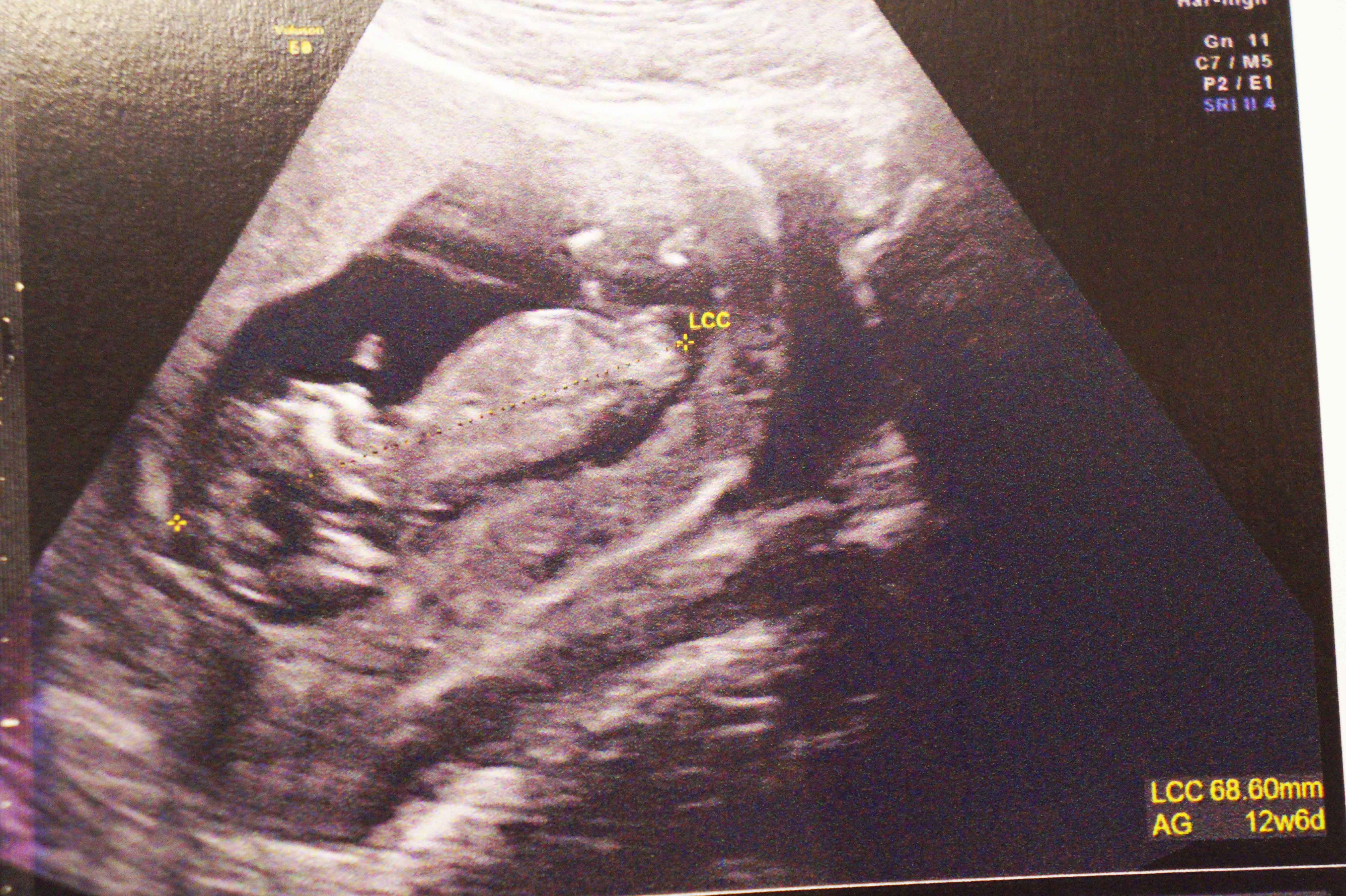 18sa 4 Fille Mais J Ai Vu Un Zizi Echographie Connaitre Le Sexe De Votre Bebe Forum Grossesse Amp Bebe Doctissimo