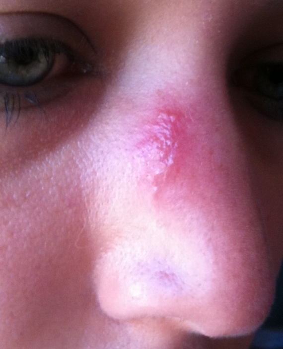 boutons bizarres en haut du nez - La Salle Détente - FORUM Santé